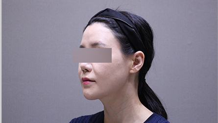 사례5 시술 전 측면