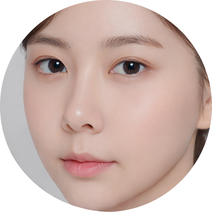 팔자주름 리프팅 후